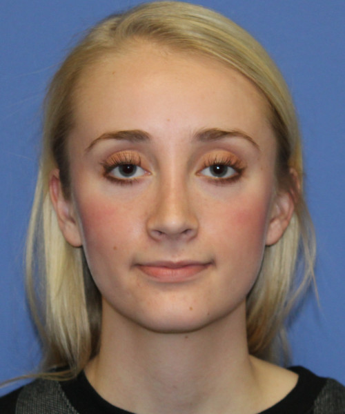 Rhinoplasty 0572 – Click HERE for more views after photo. Individual results may vary.