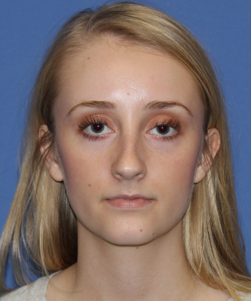 Rhinoplasty 0572 – Click HERE for more views before photo. Individual results may vary.
