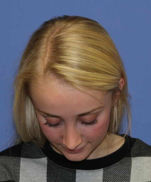 Rhinoplasty 0572 – Click HERE for more views after photo. Individual results may vary.