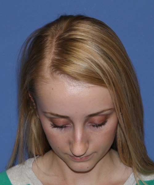 Rhinoplasty 0572 – Click HERE for more views before photo. Individual results may vary.