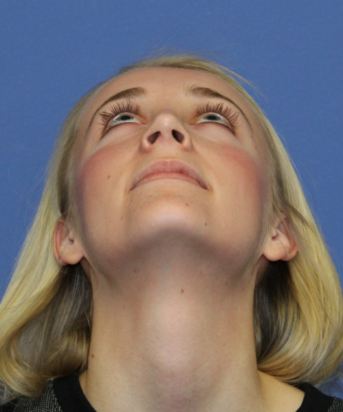 Rhinoplasty 0572 – Click HERE for more views after photo. Individual results may vary.