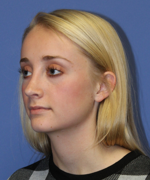Rhinoplasty 0572 – Click HERE for more views after photo. Individual results may vary.