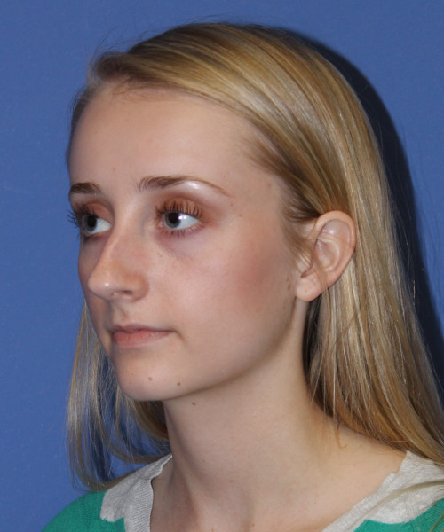 Rhinoplasty 0572 – Click HERE for more views before photo. Individual results may vary.
