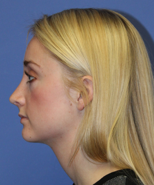 Rhinoplasty 0572 – Click HERE for more views after photo. Individual results may vary.