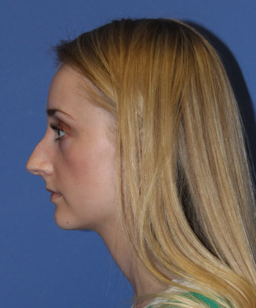 Rhinoplasty 0572 – Click HERE for more views before photo. Individual results may vary.