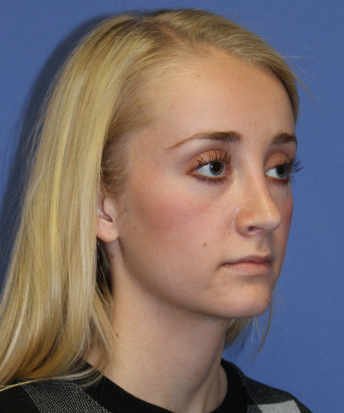 Rhinoplasty 0572 – Click HERE for more views after photo. Individual results may vary.