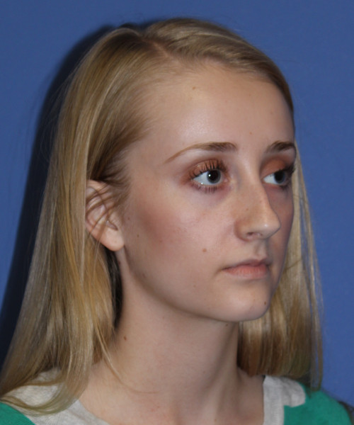 Rhinoplasty 0572 – Click HERE for more views before photo. Individual results may vary.