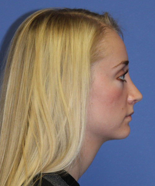 Rhinoplasty 0572 – Click HERE for more views after photo. Individual results may vary.