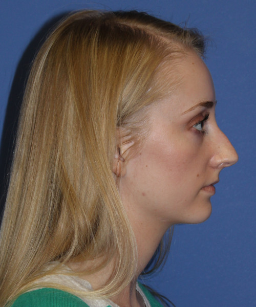 Rhinoplasty 0572 – Click HERE for more views before photo. Individual results may vary.