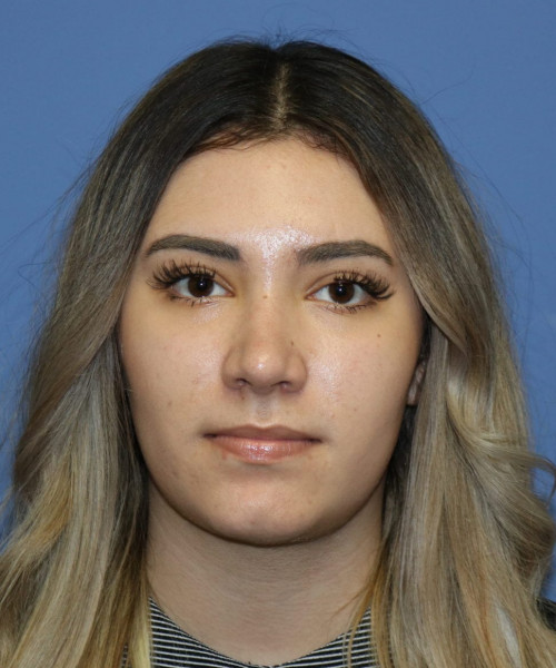 Rhinoplasty #5781 – click HERE for more views after photo. Individual results may vary.