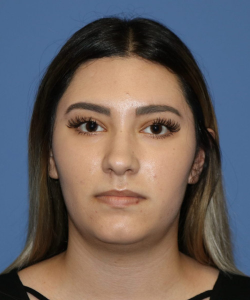 Rhinoplasty #5781 – click HERE for more views before photo. Individual results may vary.