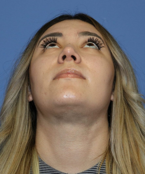 Rhinoplasty #5781 – click HERE for more views after photo. Individual results may vary.