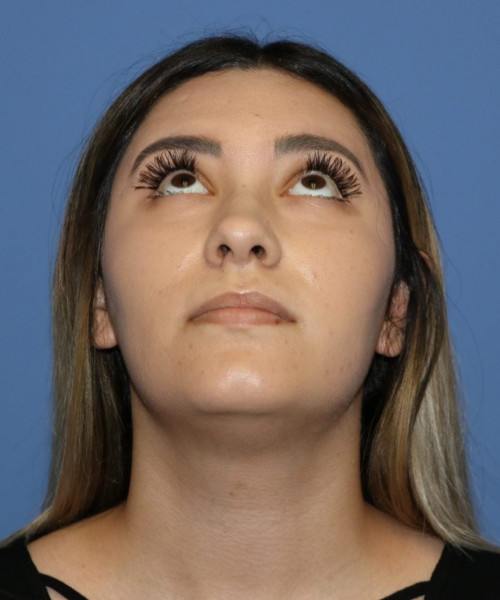 Rhinoplasty #5781 – click HERE for more views before photo. Individual results may vary.