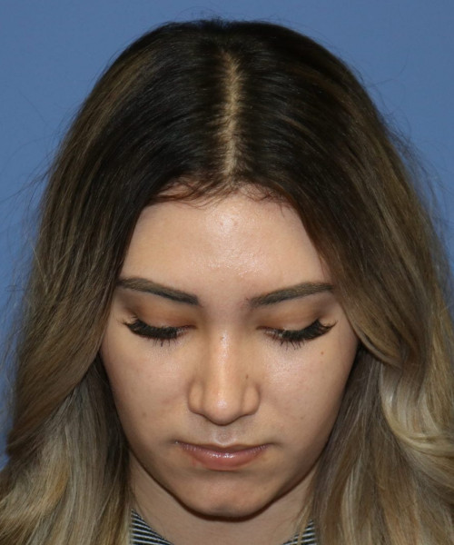 Rhinoplasty #5781 – click HERE for more views after photo. Individual results may vary.
