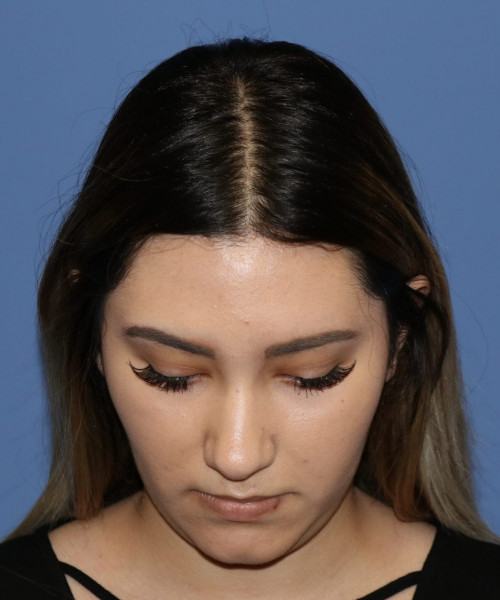 Rhinoplasty #5781 – click HERE for more views before photo. Individual results may vary.