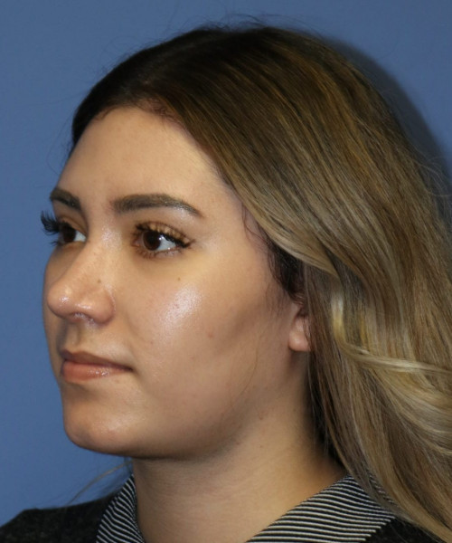 Rhinoplasty #5781 – click HERE for more views after photo. Individual results may vary.