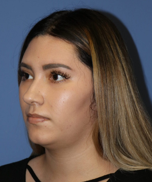 Rhinoplasty #5781 – click HERE for more views before photo. Individual results may vary.