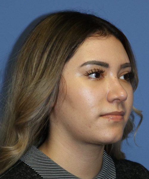 Rhinoplasty #5781 – click HERE for more views after photo. Individual results may vary.