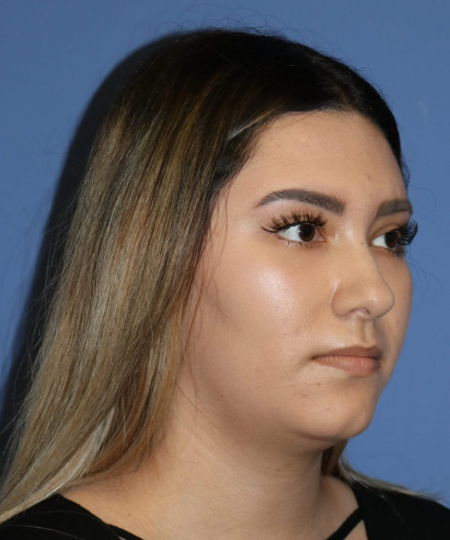 Rhinoplasty #5781 – click HERE for more views before photo. Individual results may vary.