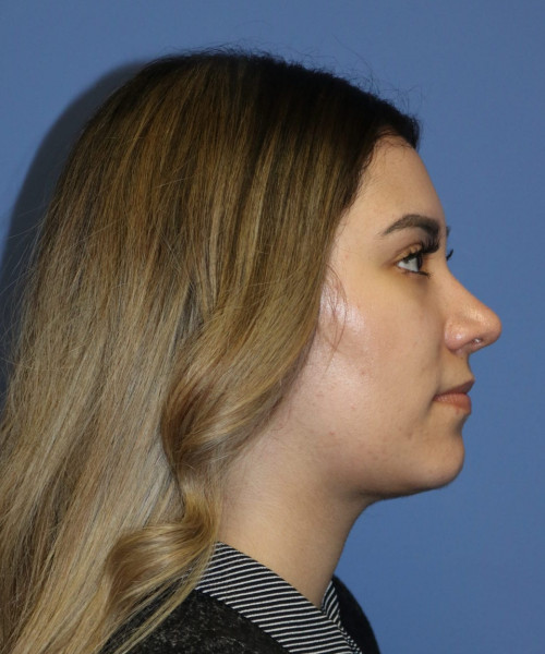 Rhinoplasty #5781 – click HERE for more views after photo. Individual results may vary.