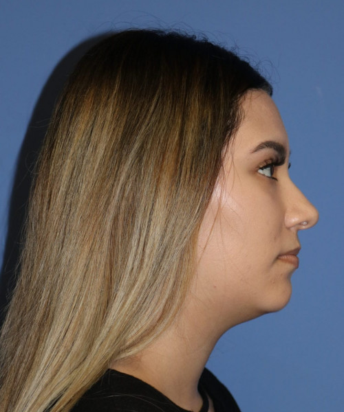 Rhinoplasty #5781 – click HERE for more views before photo. Individual results may vary.