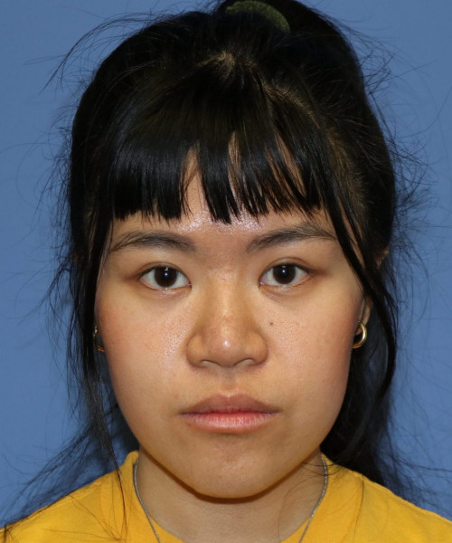 Rhinoplasty #5796 – click HERE for more views after photo. Individual results may vary.