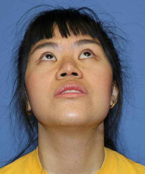 Rhinoplasty #5796 – click HERE for more views after photo. Individual results may vary.