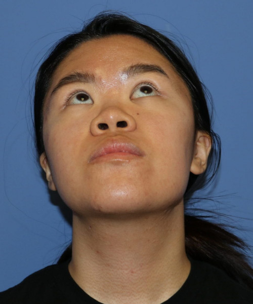 Rhinoplasty #5796 – click HERE for more views before photo. Individual results may vary.