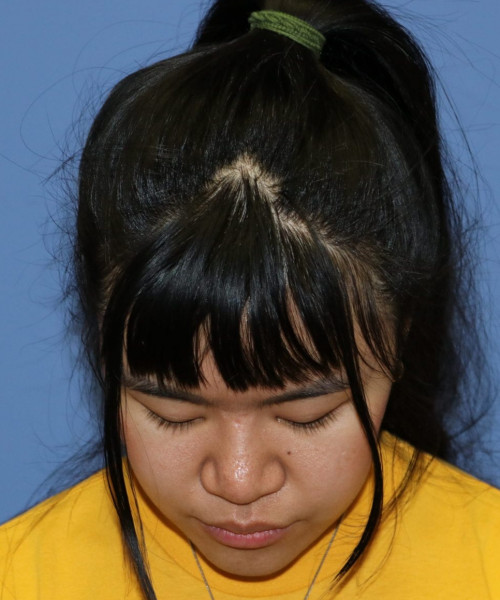 Rhinoplasty #5796 – click HERE for more views after photo. Individual results may vary.