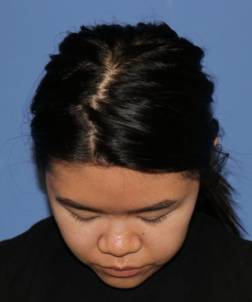 Rhinoplasty #5796 – click HERE for more views before photo. Individual results may vary.