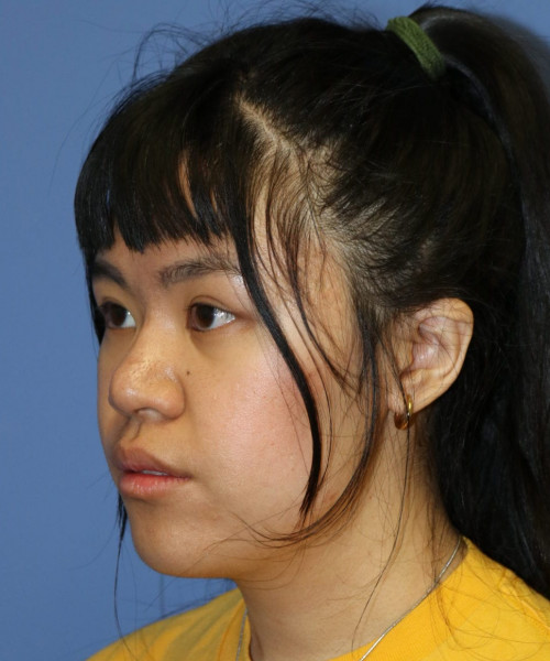 Rhinoplasty #5796 – click HERE for more views after photo. Individual results may vary.