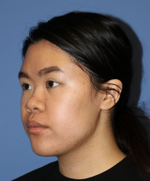 Rhinoplasty #5796 – click HERE for more views before photo. Individual results may vary.