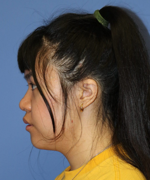 Rhinoplasty #5796 – click HERE for more views after photo. Individual results may vary.