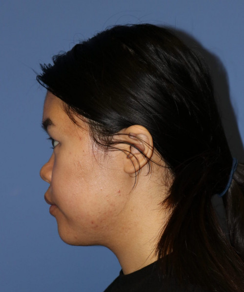 Rhinoplasty #5796 – click HERE for more views before photo. Individual results may vary.