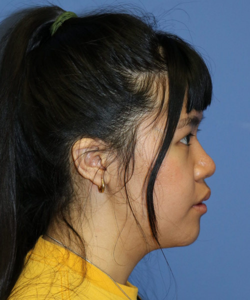 Rhinoplasty #5796 – click HERE for more views after photo. Individual results may vary.