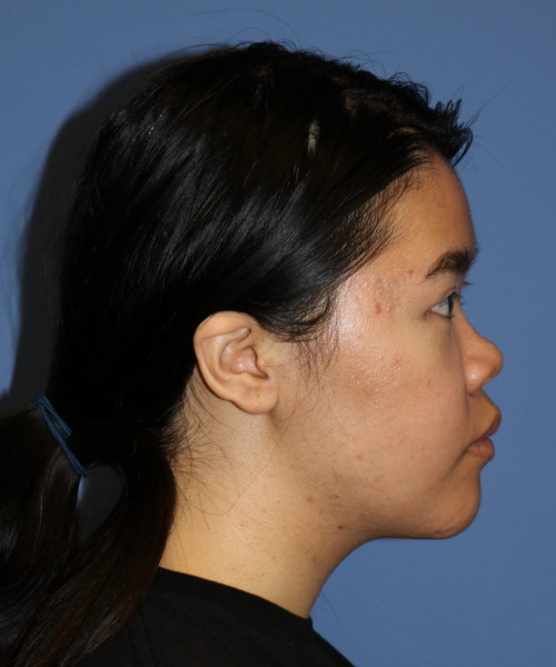 Rhinoplasty #5796 – click HERE for more views before photo. Individual results may vary.