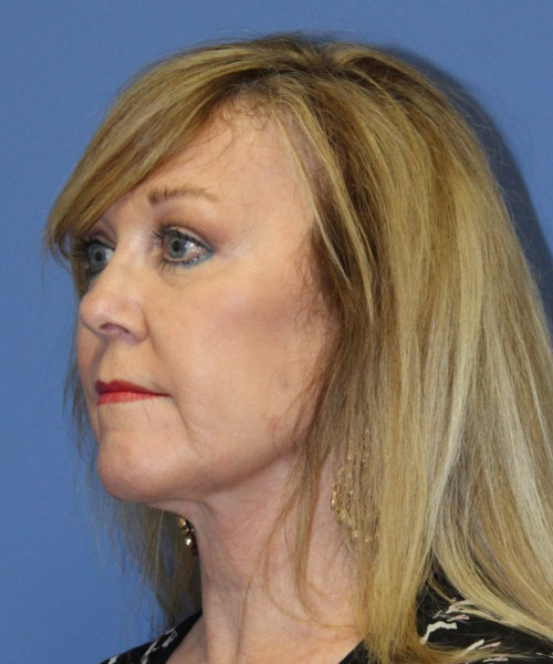 Facelift #5882 – click HERE for more views after photo. Individual results may vary.