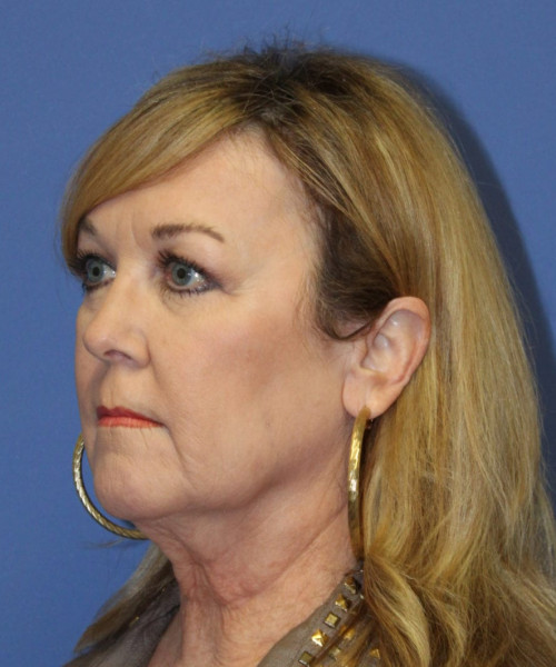 Facelift #5882 – click HERE for more views before photo. Individual results may vary.