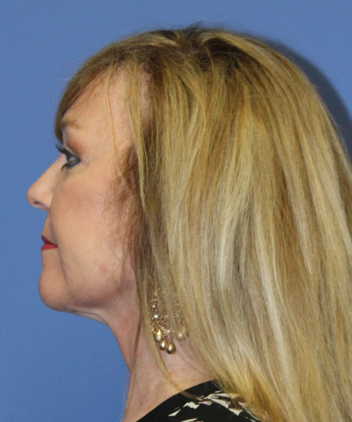 Facelift #5882 – click HERE for more views after photo. Individual results may vary.