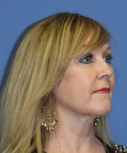 Facelift #5882 – click HERE for more views after photo. Individual results may vary.