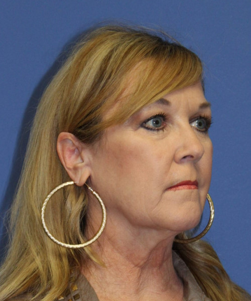 Facelift #5882 – click HERE for more views before photo. Individual results may vary.