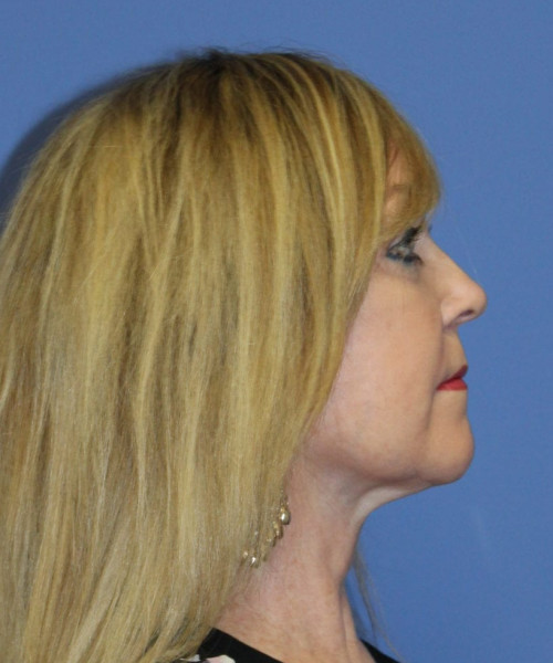 Facelift #5882 – click HERE for more views after photo. Individual results may vary.