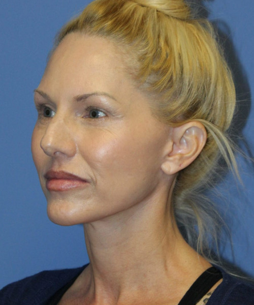 Facelift #5923 – click HERE for more views after photo. Individual results may vary.