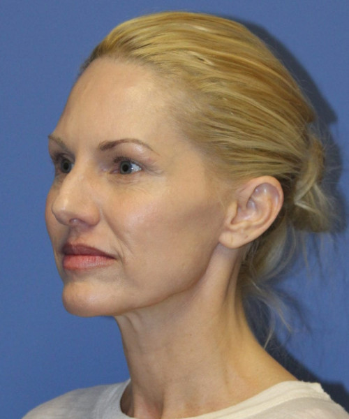 Facelift #5923 – click HERE for more views before photo. Individual results may vary.