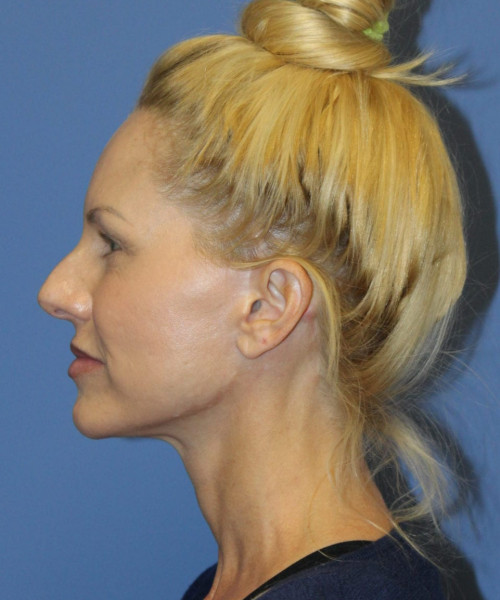 Facelift #5923 – click HERE for more views after photo. Individual results may vary.