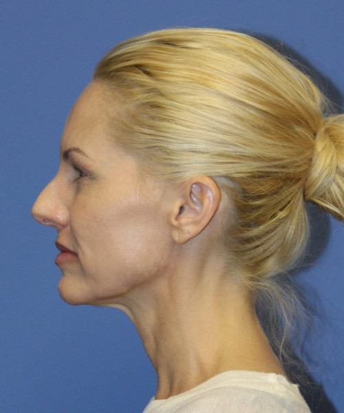 Facelift #5923 – click HERE for more views before photo. Individual results may vary.