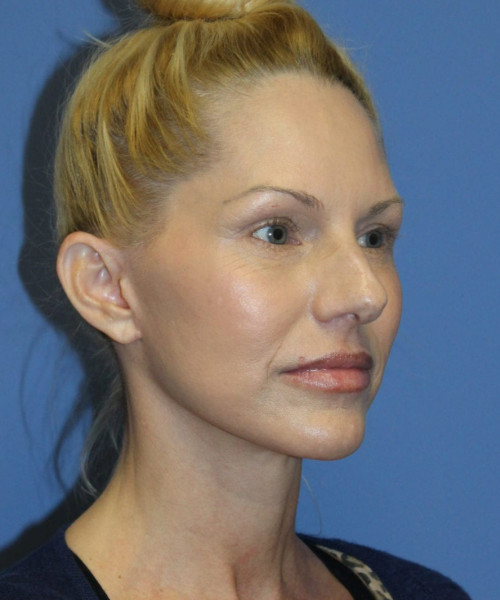 Facelift #5923 – click HERE for more views after photo. Individual results may vary.