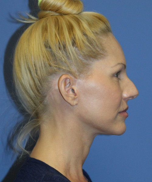 Facelift #5923 – click HERE for more views after photo. Individual results may vary.