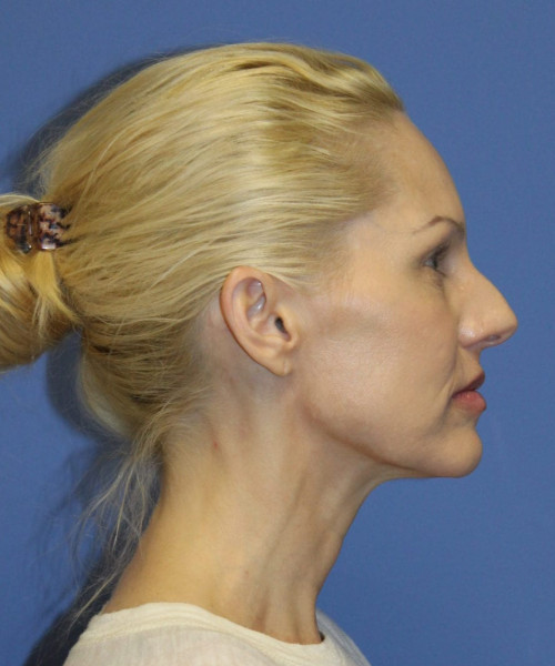 Facelift #5923 – click HERE for more views before photo. Individual results may vary.