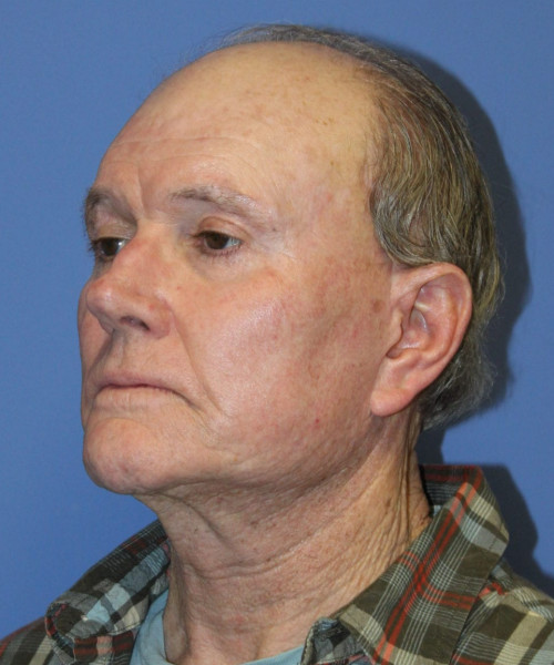 Facelift # 5959 – click HERE for more views after photo. Individual results may vary.
